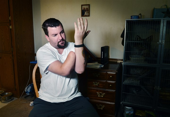 Early hand transplants show mixed success