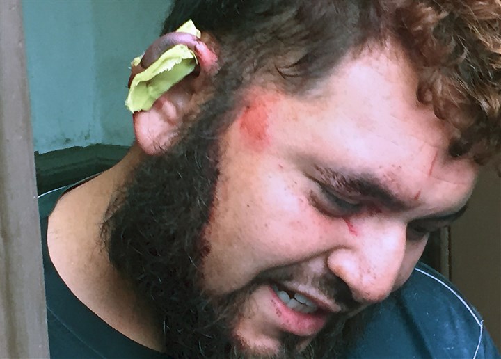 Pittsburgh man's ear bitten off during argument