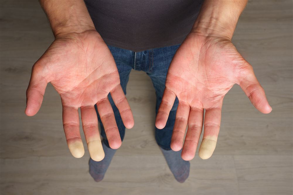 Hands Fingers Turning Blue